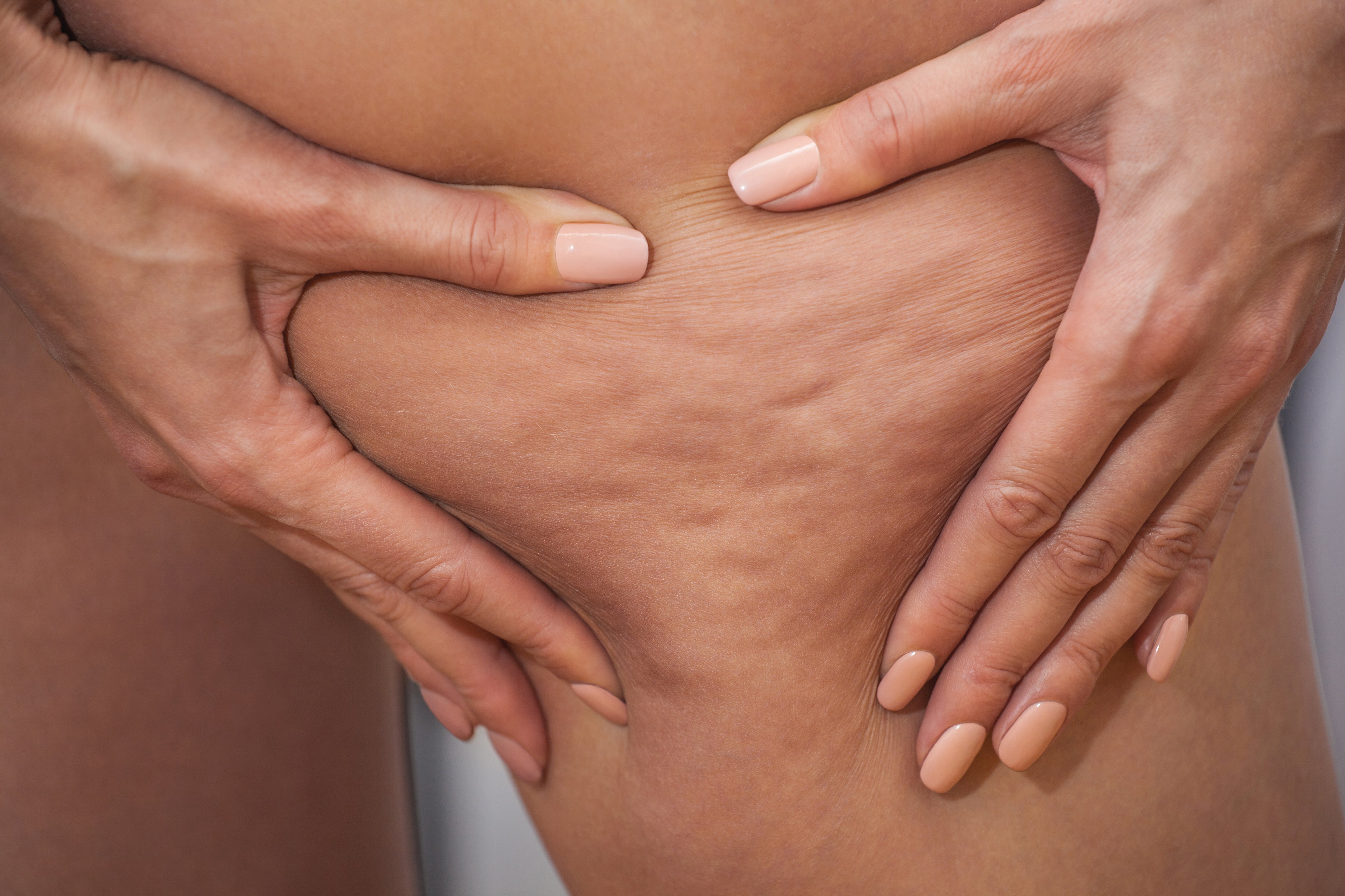 Comment réduire l'apparence de la cellulite naturellement ?